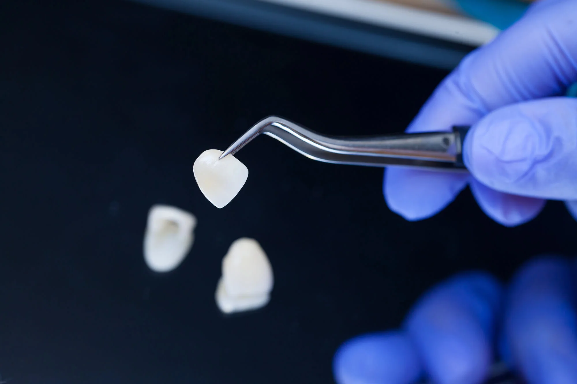 Dental-Veneers-in-Livonia-MI