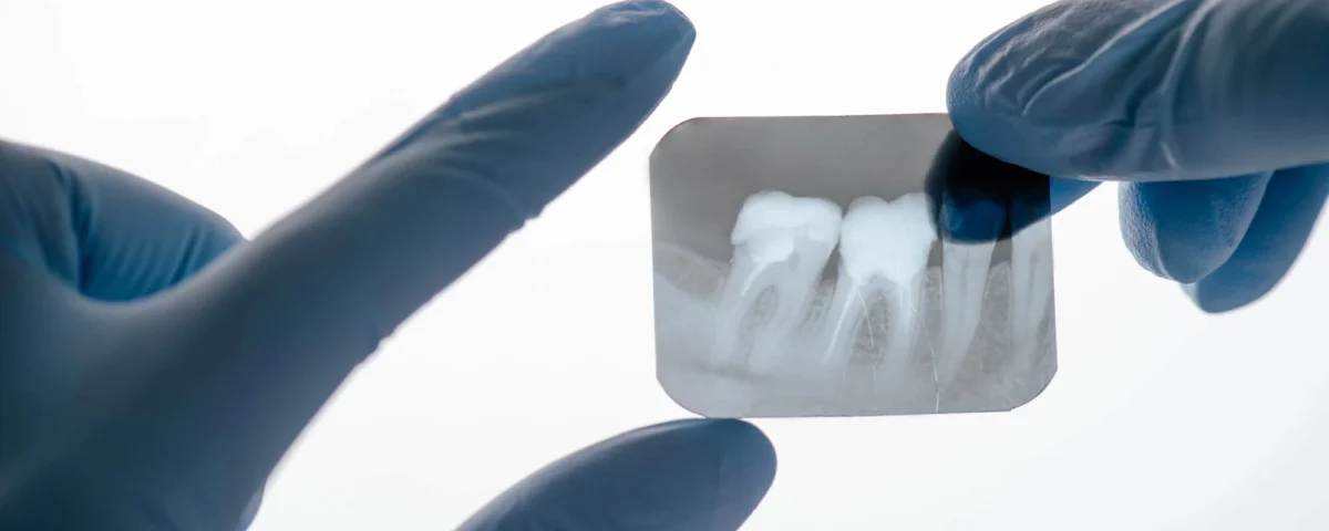 Emergency Dentist in Livonia-MI-Explains-What-to-Do-If-You-Loose-a-Dental-Filling
