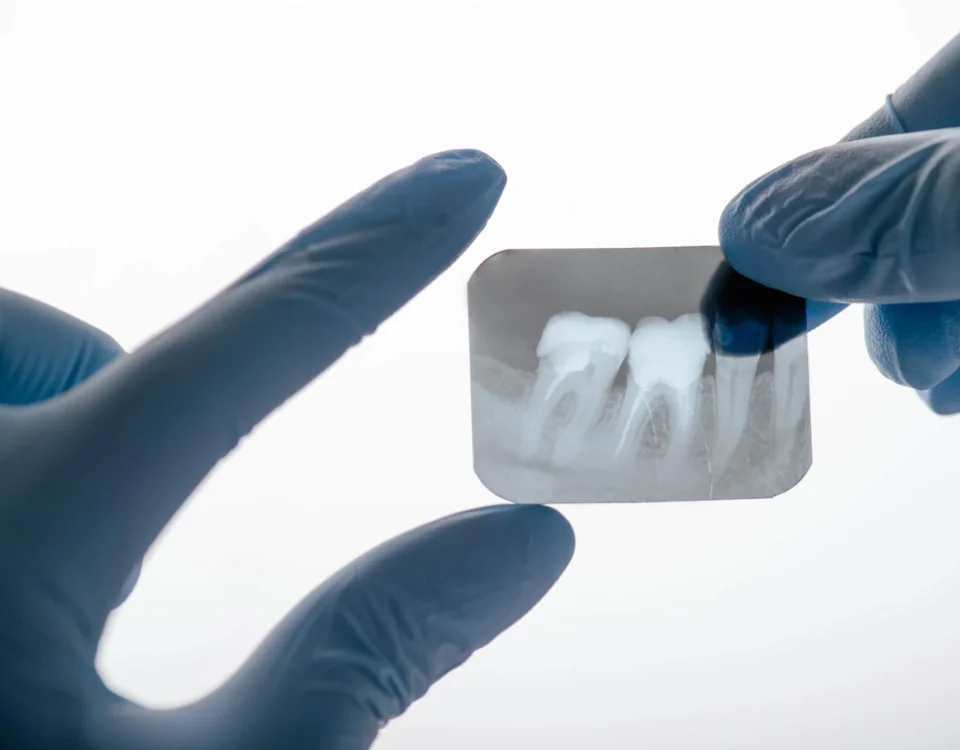Emergency Dentist in Livonia-MI-Explains-What-to-Do-If-You-Loose-a-Dental-Filling