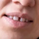 How-a-Cometic-Dentist-in-Livonia-MI-Fixes-diastema-with-Bonding