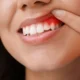 What-Is-a-Distal-Wedge-Procedure-in-Michigan
