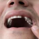 How ot Avoid Avulsion