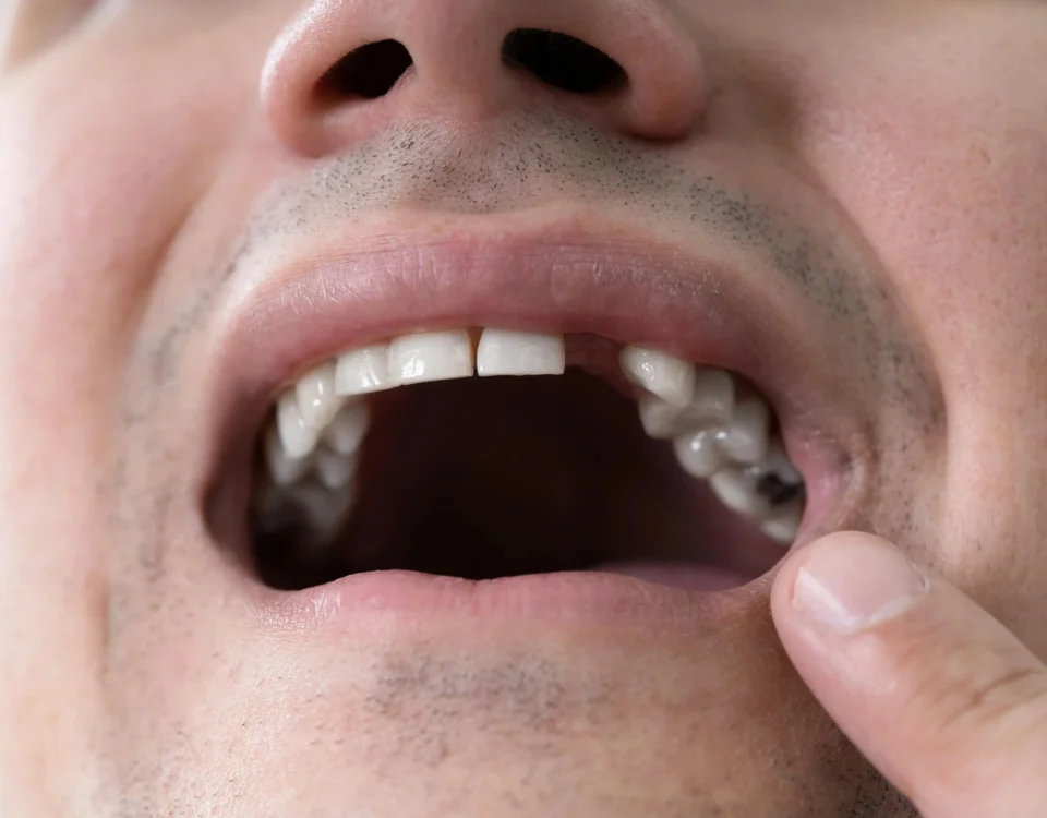 How ot Avoid Avulsion