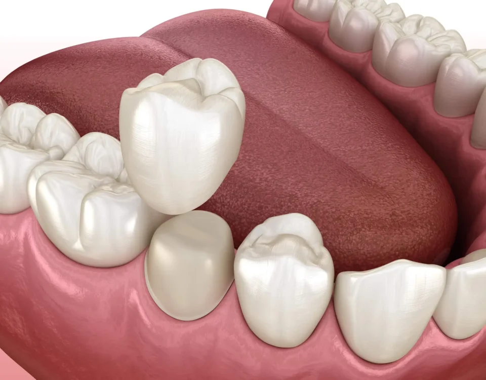 How to Care for Dental Crown Restorations in Livonia MI
