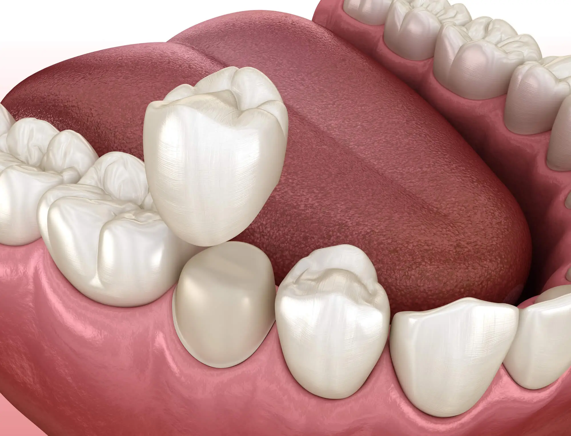 How to Care for Dental Crown Restorations in Livonia MI