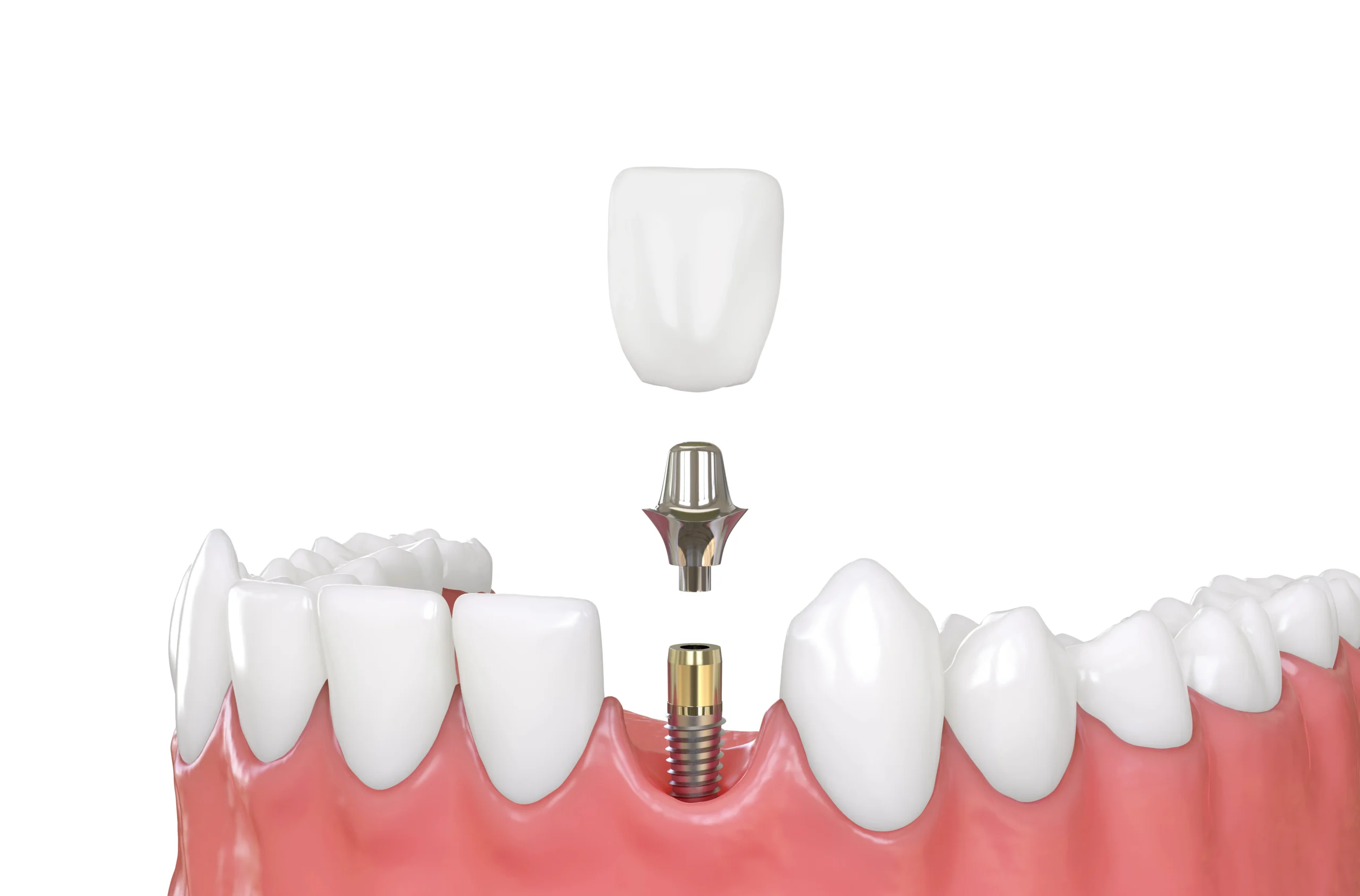 Illustration of Dental Implants in Livonia