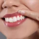 dental veneers healthy gums smile