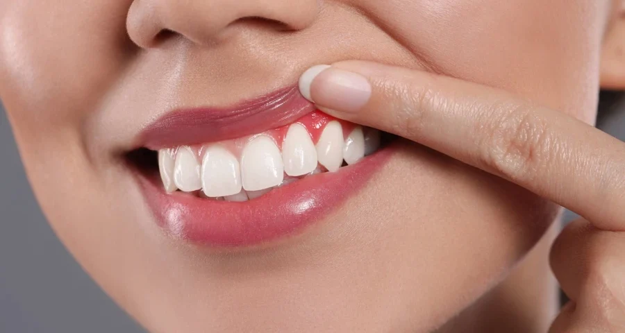 dental veneers healthy gums smile
