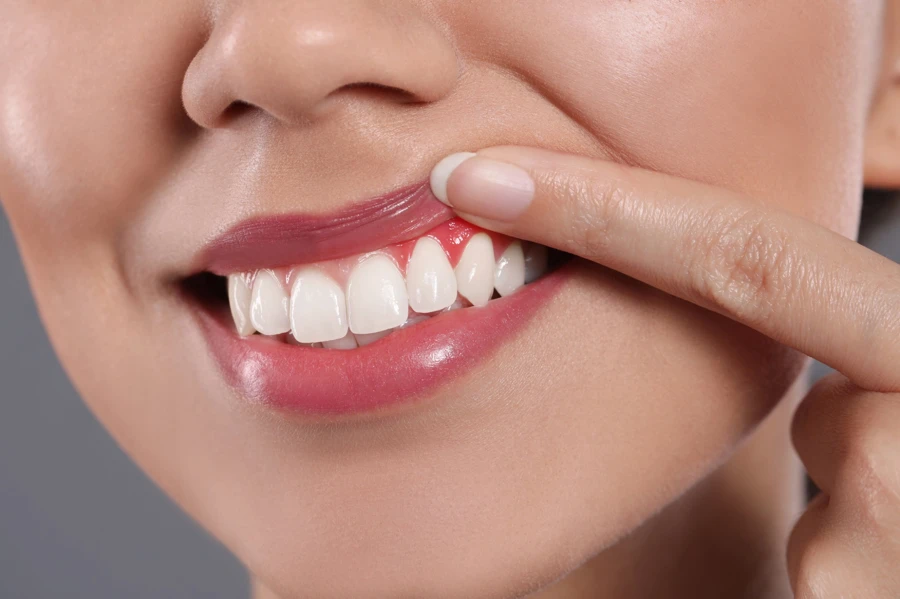 dental veneers healthy gums smile