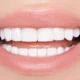 after-Teeth-Whitening-Livonia-MI