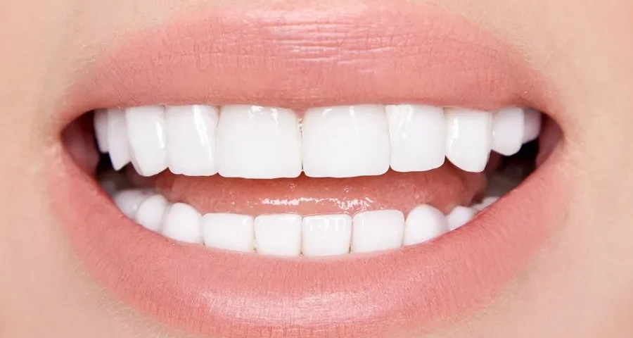 after-Teeth-Whitening-Livonia-MI