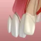 distal wedge procedure michigan gum surgery illustration