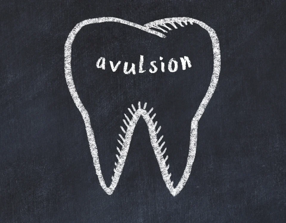 tooth avulsion educational dental diagram