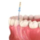 Root canal procedure illustration showing infected tooth treatment in Livonia MI