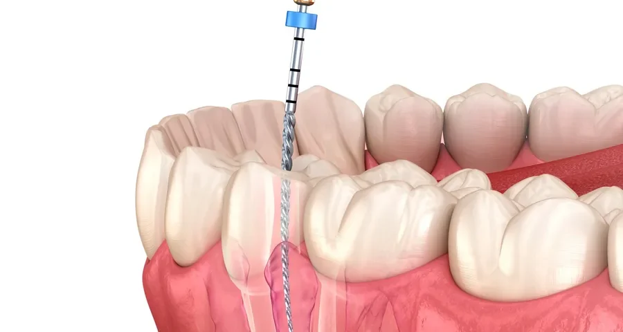 Root canal procedure illustration showing infected tooth treatment in Livonia MI
