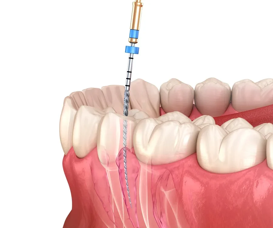 Root canal procedure illustration showing infected tooth treatment in Livonia MI