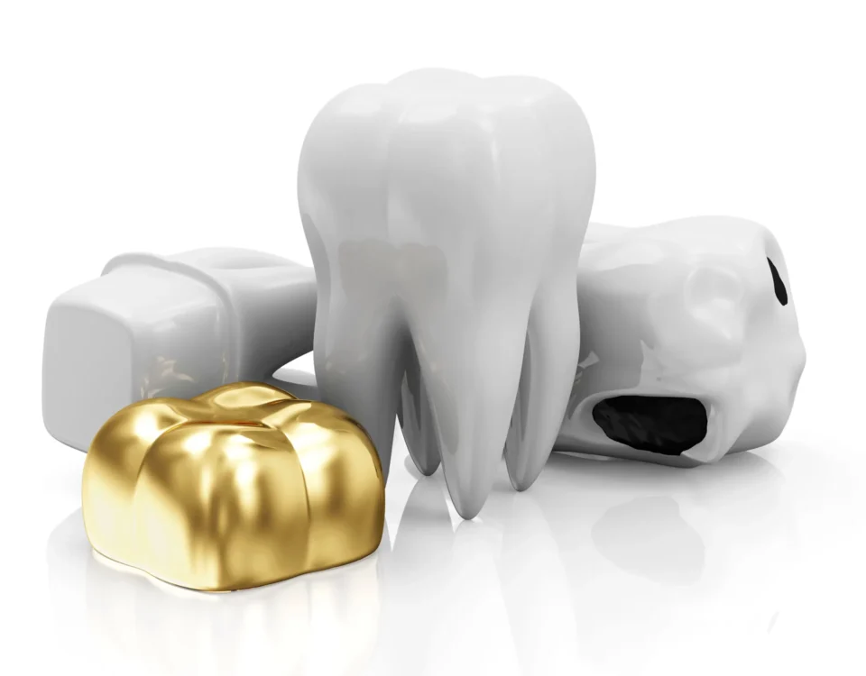 dental-crown-restorations-livonia-mi-tooth-restoration