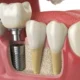 implant-restorations-livonia-mi-implant-placement