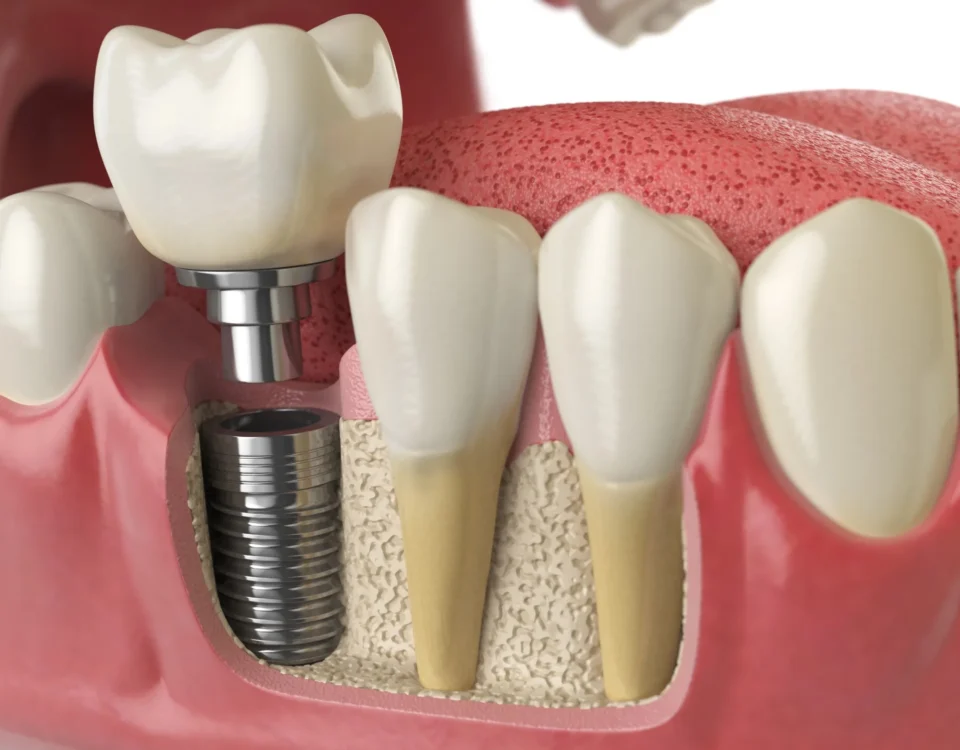 implant-restorations-livonia-mi-implant-placement